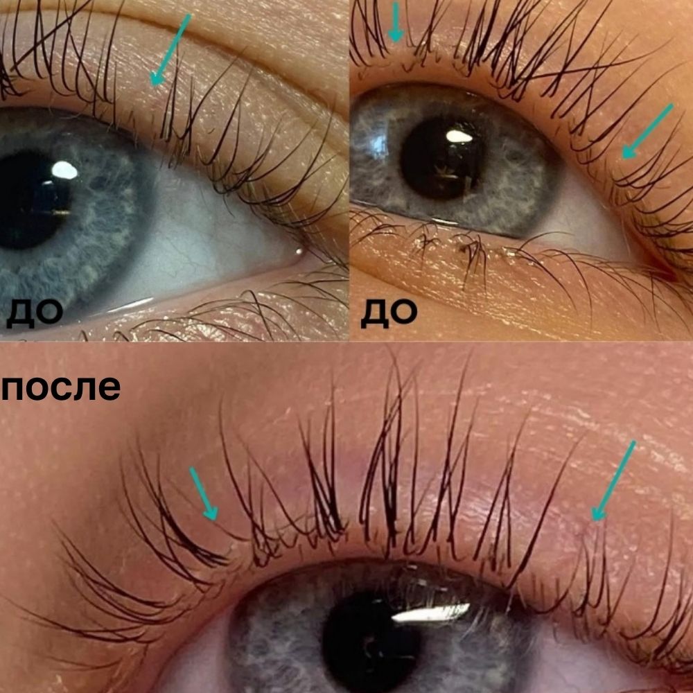 Careprost