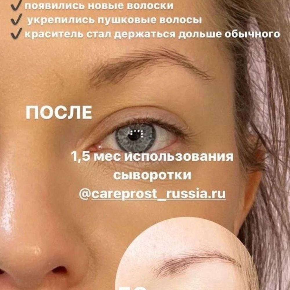 Careprost